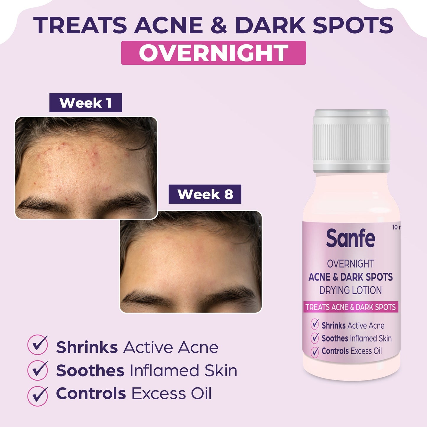 Sanfe Overnight Acne  Dark Spots Drying Lotion - 10ml