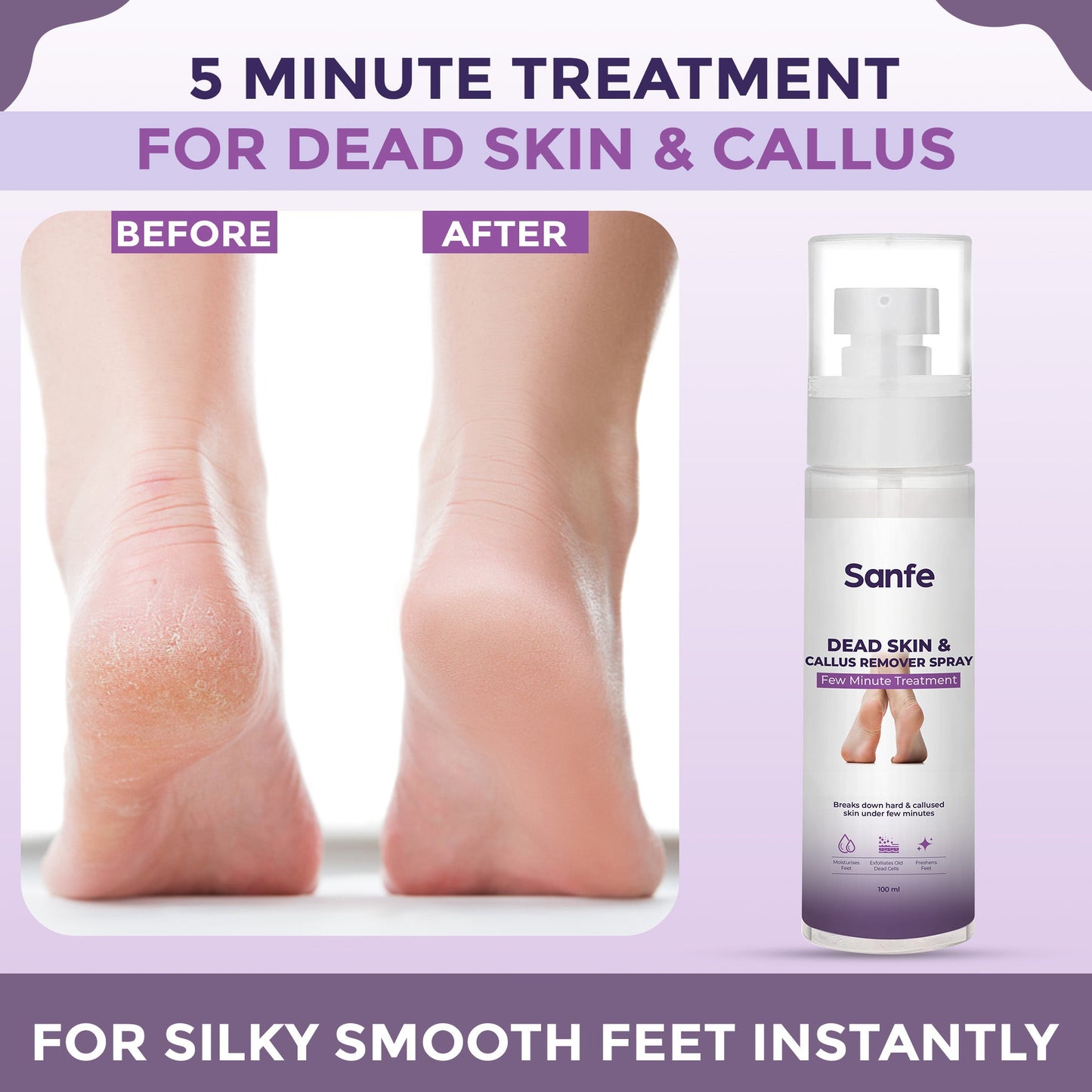 Sanfe Dead Skin  Callus Remover Spray - 100ml